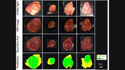 Exposing Hidden Tumors With Near-Infrared Imaging and Machine Learning Methods