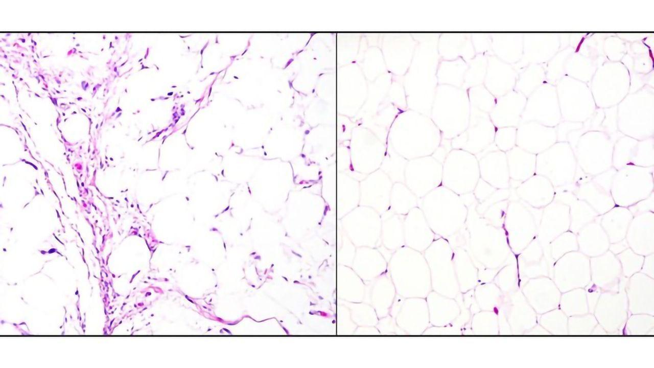 Team Develops a Fast and Accurate Diagnostic Test for Liposarcomas