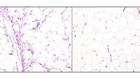 Team Develops a Fast and Accurate Diagnostic Test for Liposarcomas
