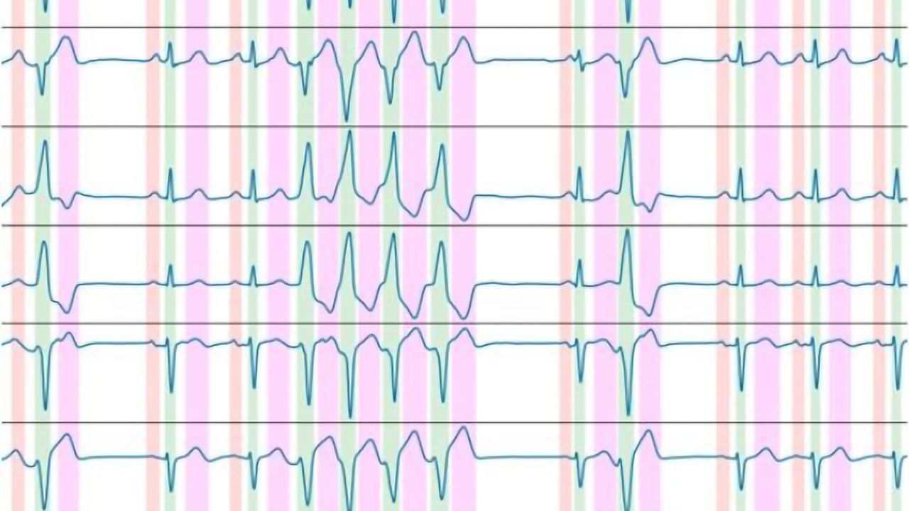 New Algorithm Can Automate ECG Recording