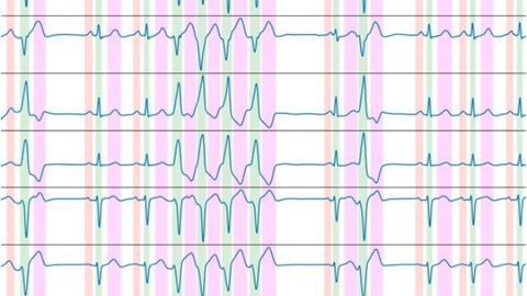 New Algorithm Can Automate ECG Recording