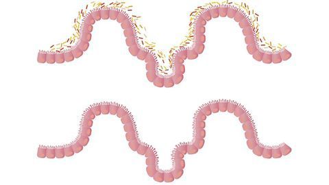 Improved Outcomes in Blood Cancers by Protecting Gut Integrity