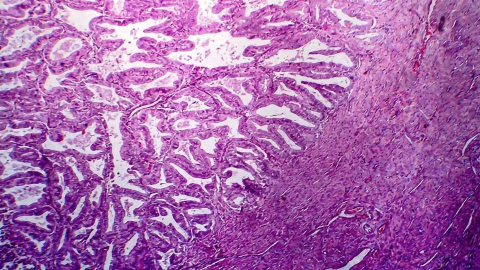 New Test Enables Non-Invasive Detection of Endometrial Cancer content piece image