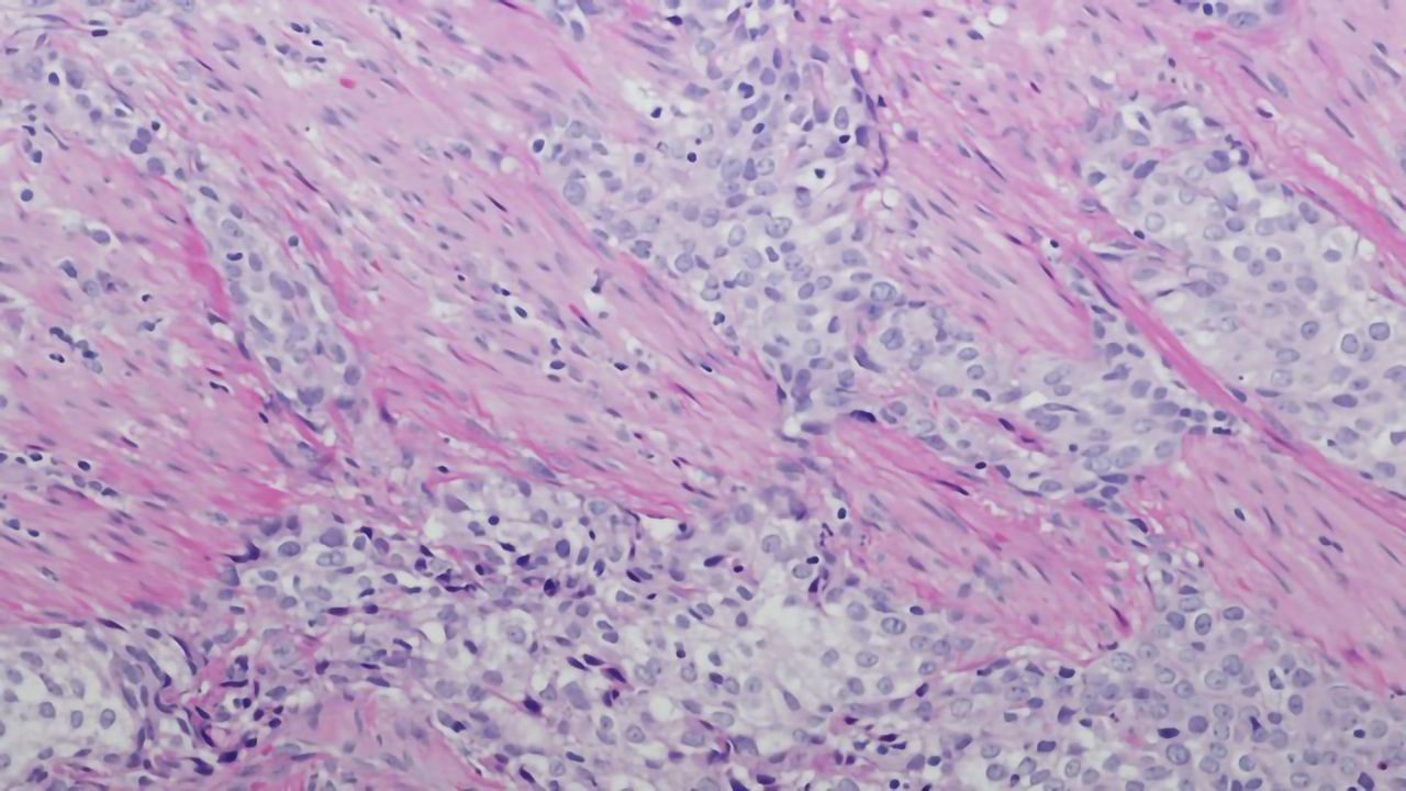 Antibody–Drug Conjugate Reduces Risk of Death by 30% in Patients With Common Bladder Cancer