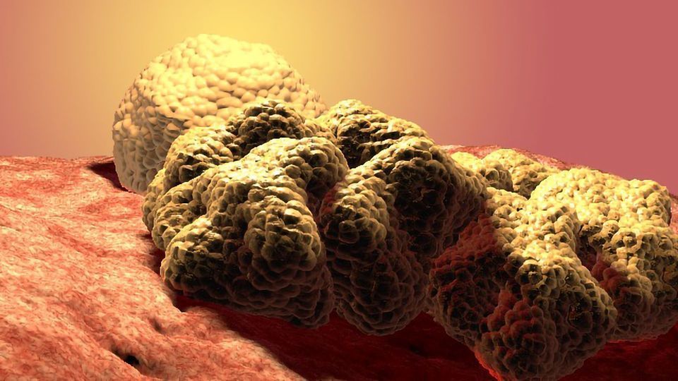 Cancer Cells Deform To Squeeze Past Neighboring Cells content piece image