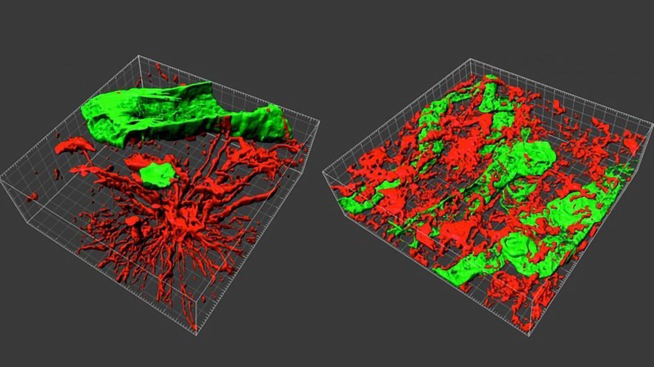 3D Biopsies Enable a Better Understanding of Brain Tumors
