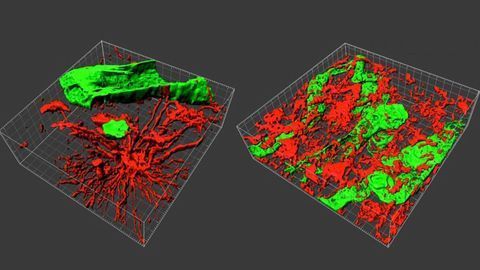 3D Biopsies Enable a Better Understanding of Brain Tumors