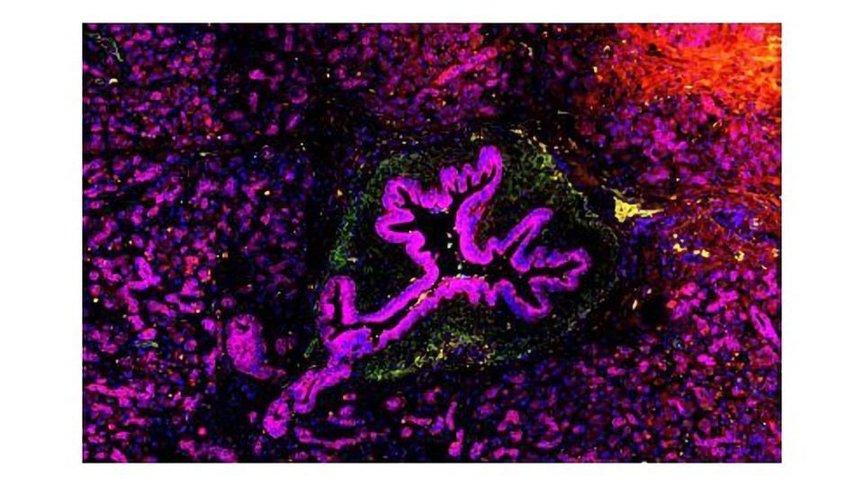The Role of Interleukin-33 in Skin and Pancreatic Cancers content piece image