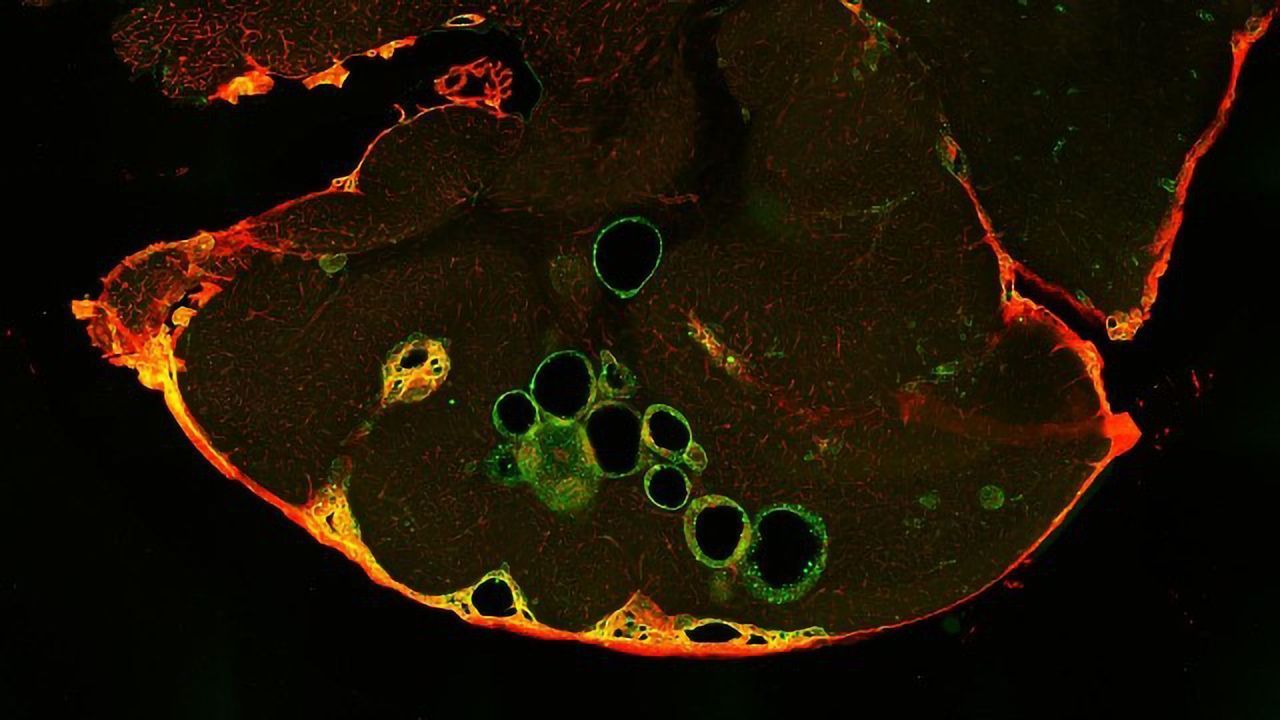 Beta Blockers Show Ability To Repair Misshapen Brain Blood Vessels