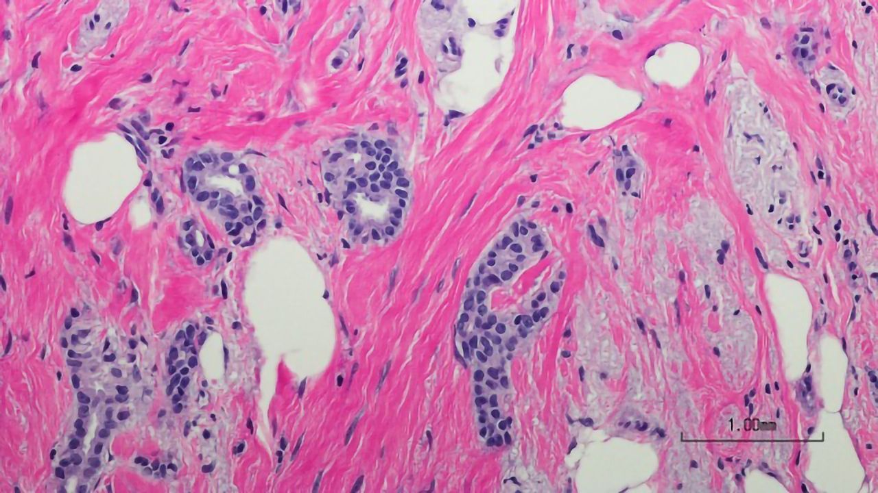 HER2 Breast Cancer Cells Adopt Strategy To Resist Immunotherapy