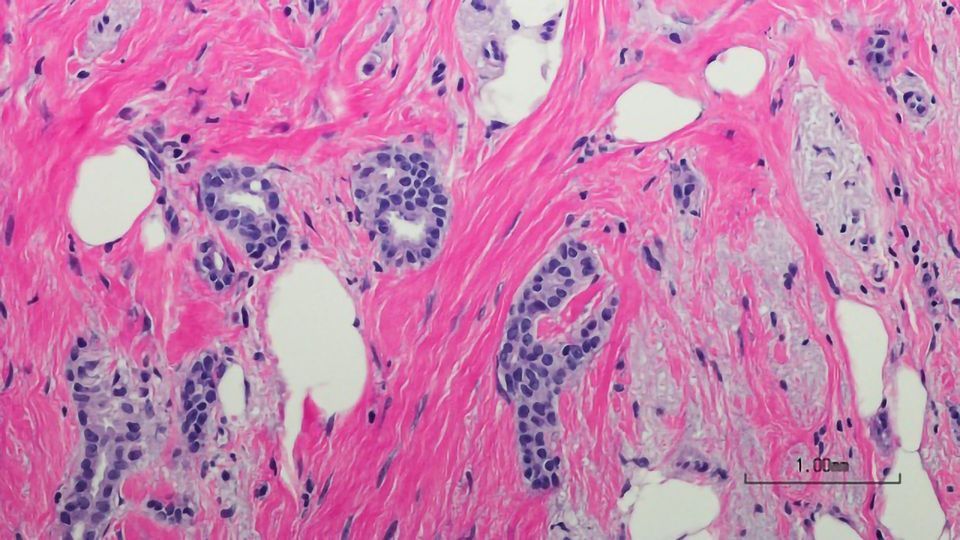 HER2 Breast Cancer Cells Adopt Strategy To Resist Immunotherapy content piece image