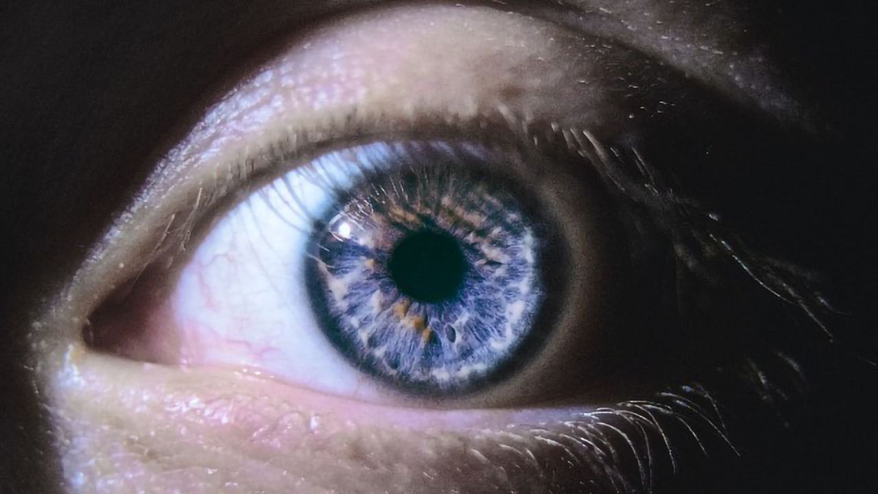 127 Glaucoma Genes Identified in Largest Study of Its Kind