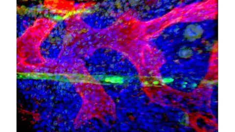 New Method Can Distinguish Cancer Stem Cells From Other Cells Based on Genetics