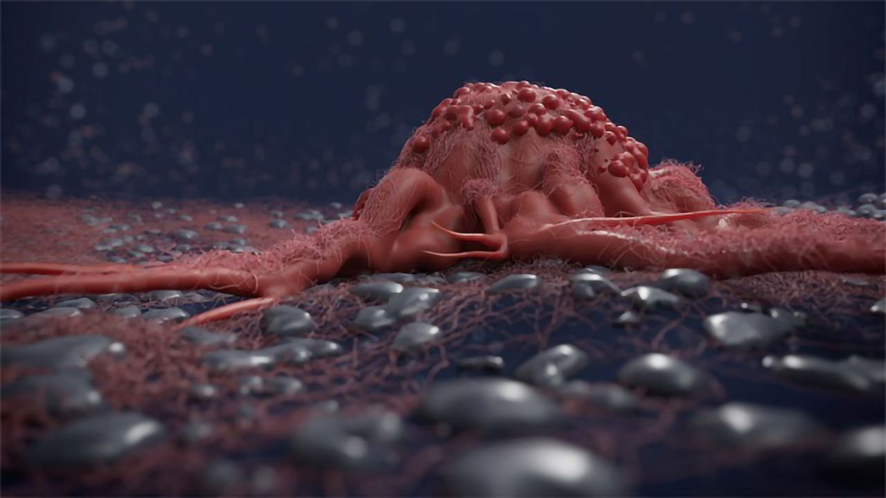 The Tumor Microenvironment: Local Effects With Widespread Consequences