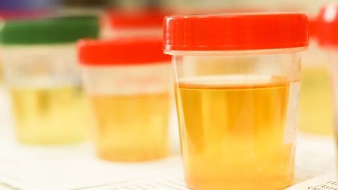 Progressive Kidney Disease May Be Predicted by Proteins in Urine