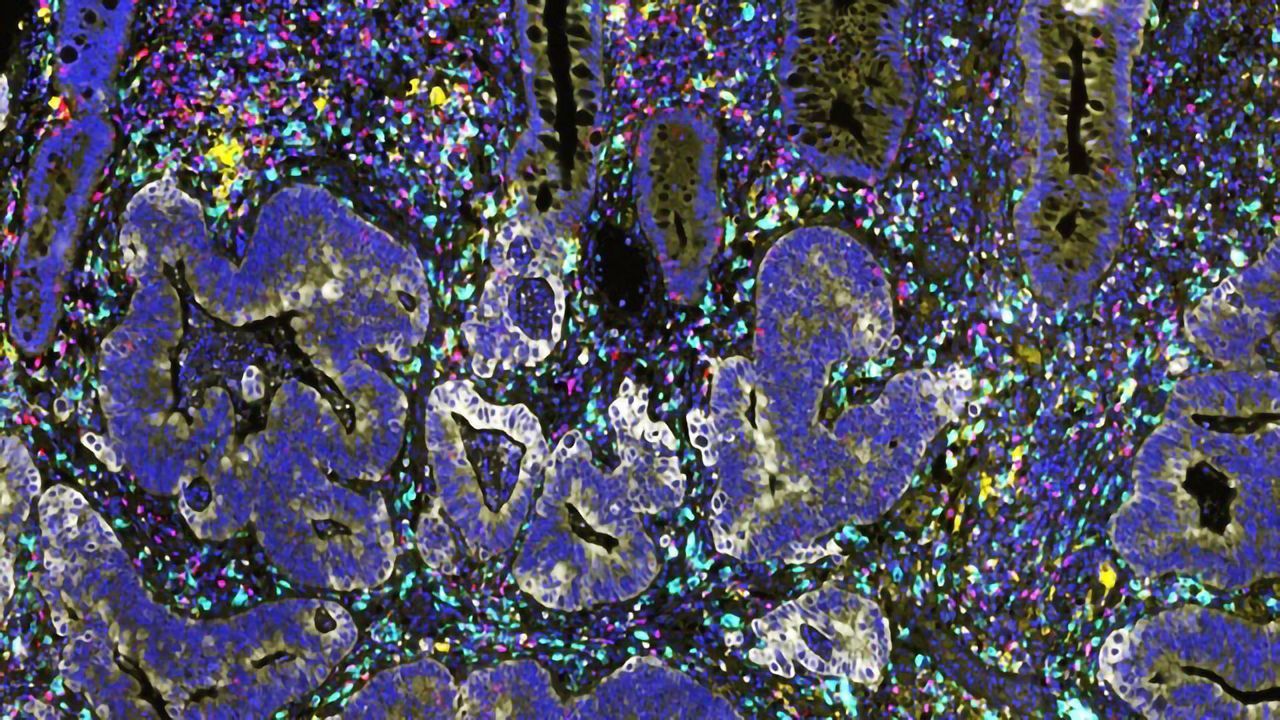 Boosting Radiotherapy Response With Targeted Immunotherapy