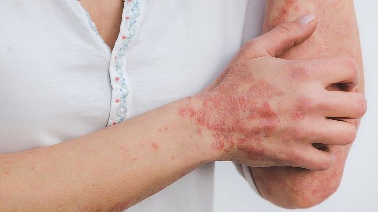 Chronic Skin Inflammation Molecular Mechanisms Identified