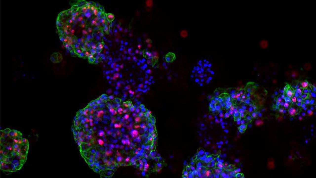Predicting Therapy Success With Individualized Models of Prostate Cancer