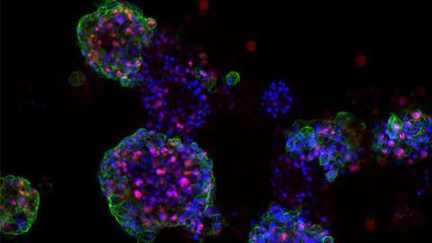Predicting Therapy Success With Individualized Models of Prostate Cancer