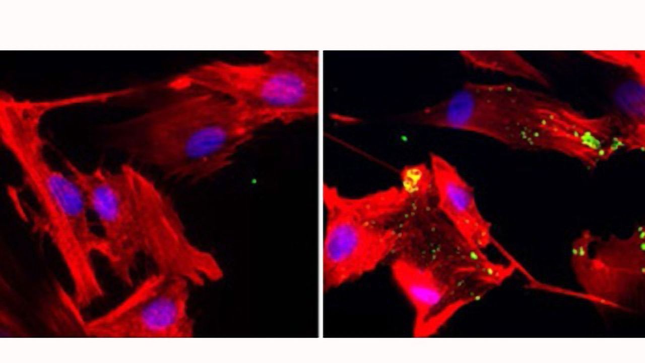 Shrinking Pancreatic Tumors by Starving Their Cellular “Neighbors”