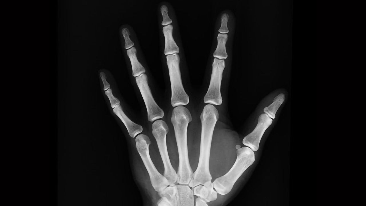 How Inflammation Leads to Bone Erosion