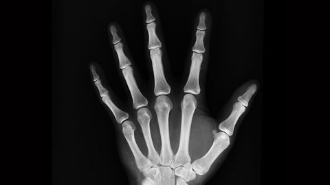 How Inflammation Leads to Bone Erosion