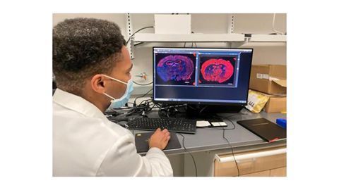 Reprogramed Cells Repair Brain Tissue Damage After Stroke