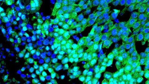 Team Discovers a Detonating Fuse for Basal-Like Breast Cancer