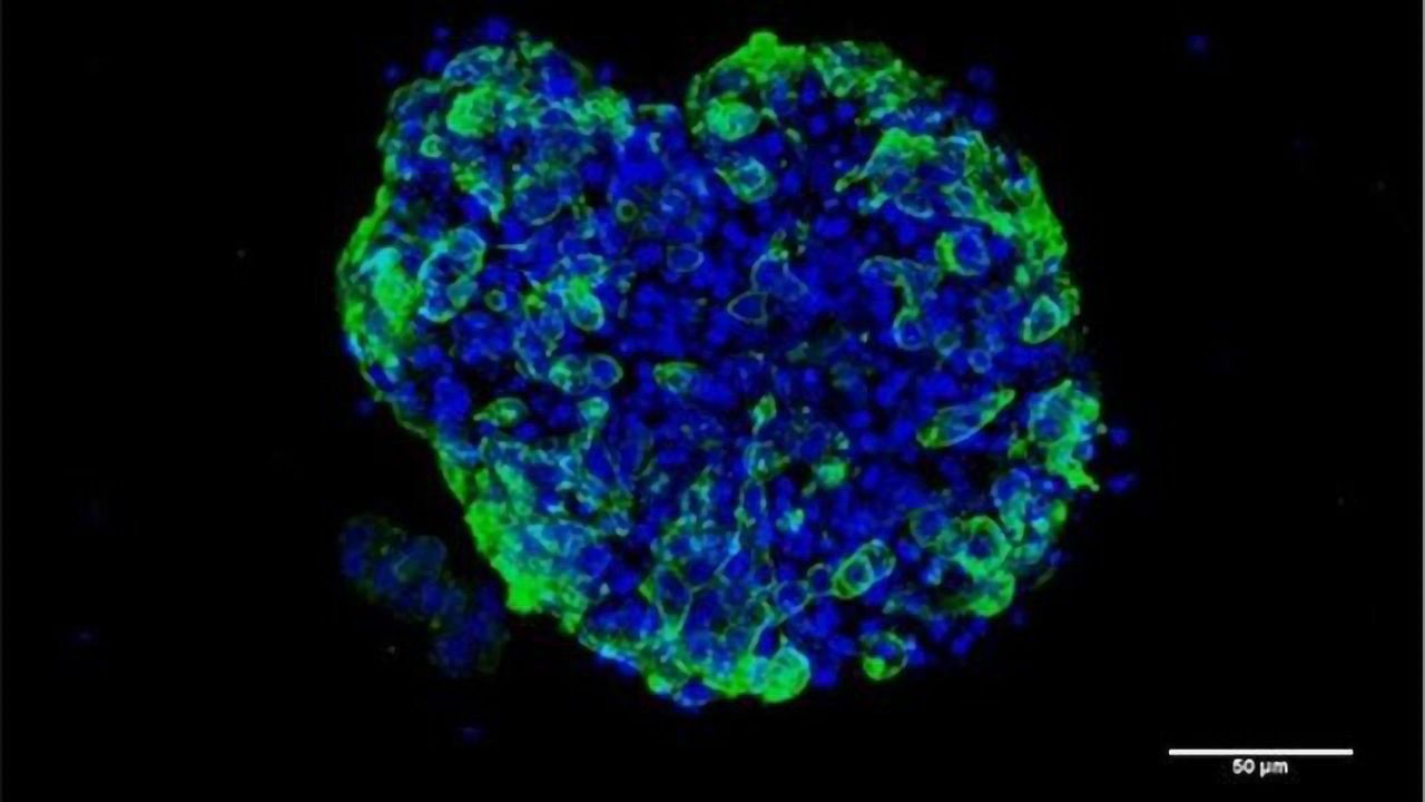 Cancer Organoid