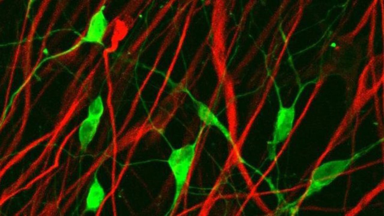 Anticancer Approach Converts Glioma Cells Into Neurons
