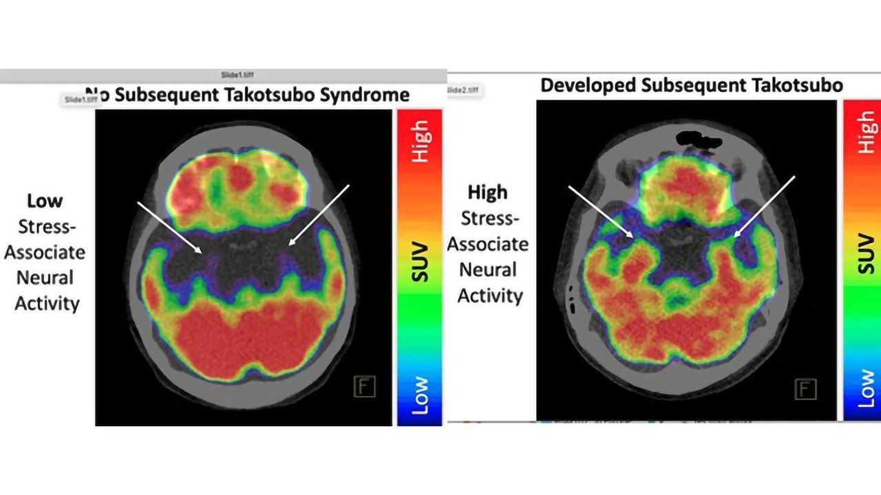 A Stressed Brain Linked to Broken Heart Syndrome