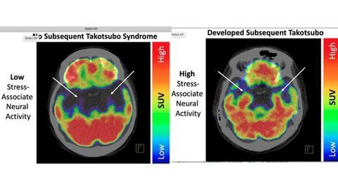 A Stressed Brain Linked to Broken Heart Syndrome