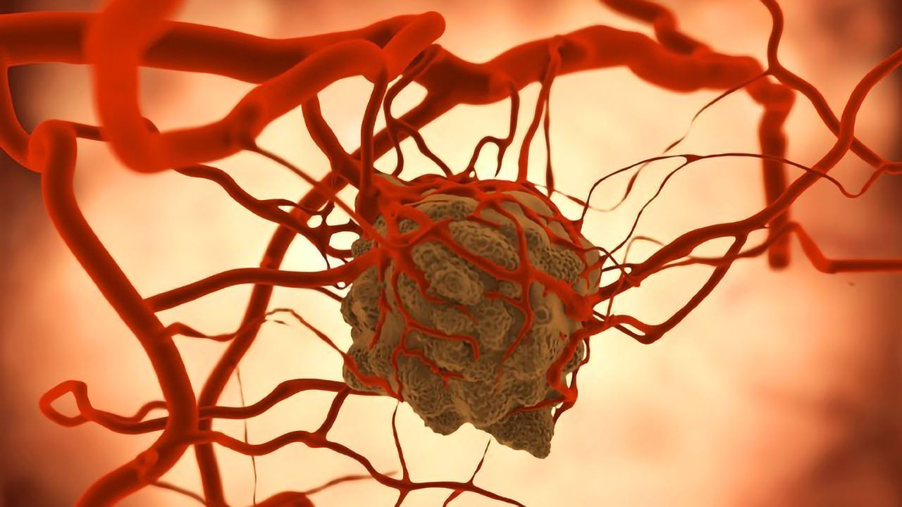 AI Used To Study Aggressive Asbestos-Related Cancer