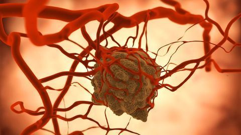 AI Used To Study Aggressive Asbestos-Related Cancer