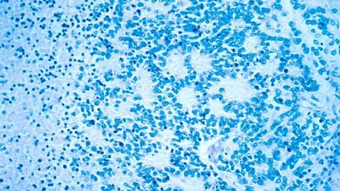 Team Pinpoints Therapeutic Protein Target for Neuroblastoma