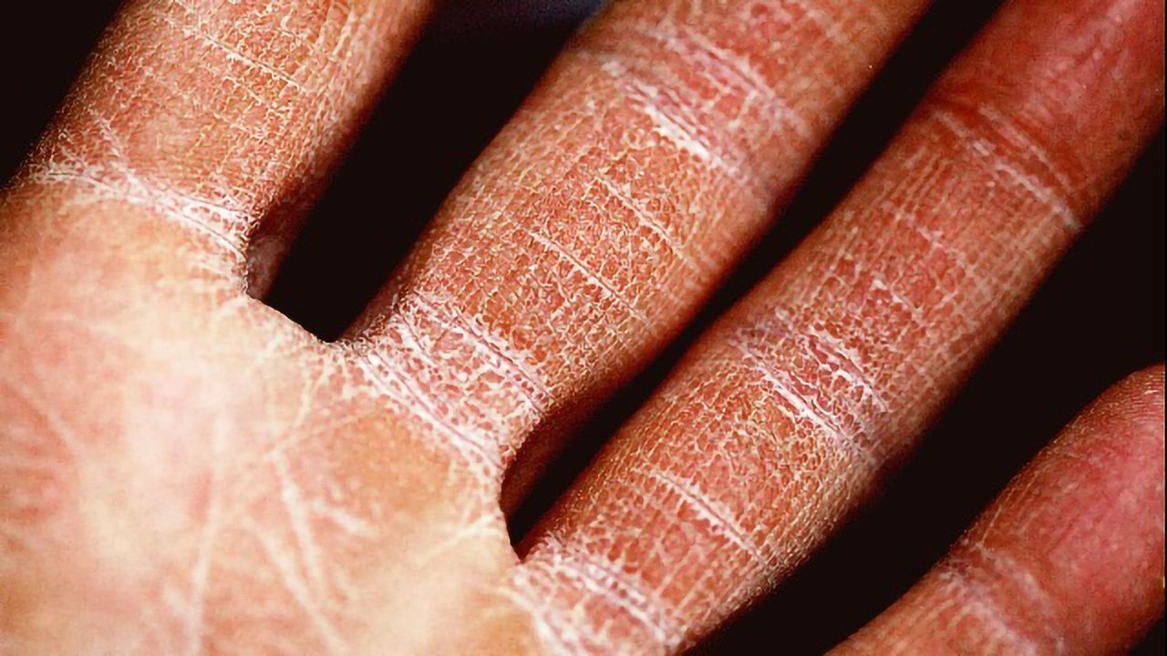 Understanding Itch: New Findings Reveal Potential Eczema Targets