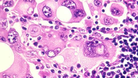 Inhibiting NLRP3 To Prevent Melanoma-Mediated Inflammation