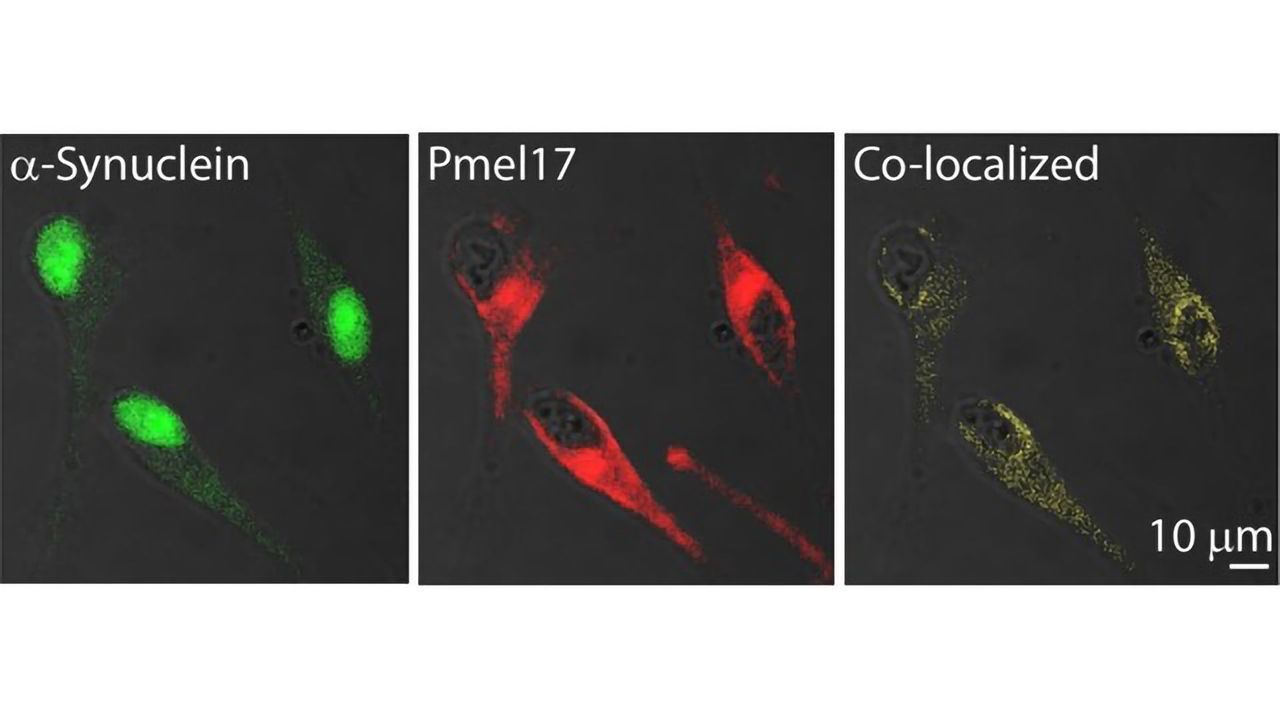 Amyloid Protein Link Identified Between Melanoma and Parkinson's