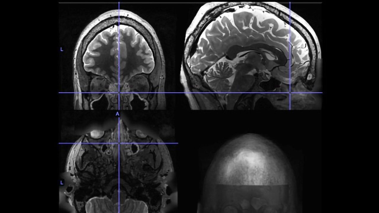 Chronic Sinusitis May Alter Brain Activity