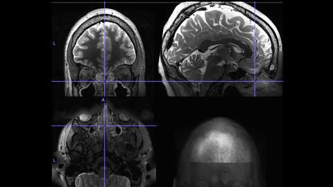 Chronic Sinusitis May Alter Brain Activity