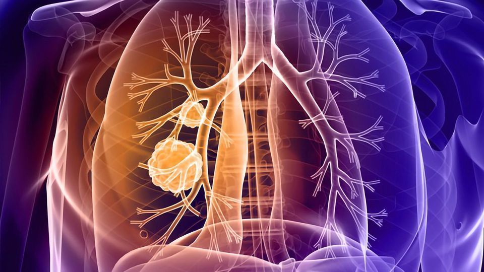 Insights Into Resistance to Immune Checkpoint Inhibitors in Lung Cancer content piece image