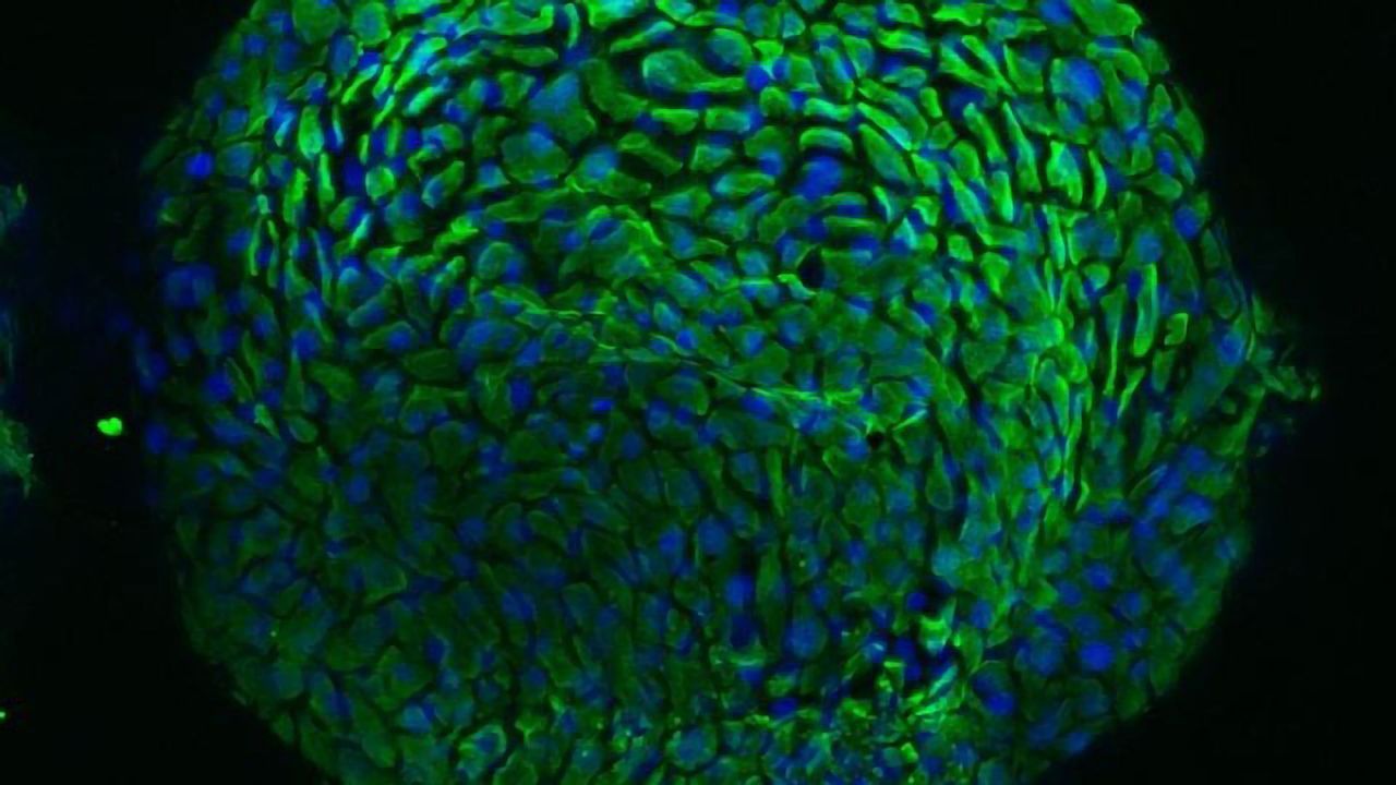 First Patient-Derived Organoid Model for Cervical Cancer Developed