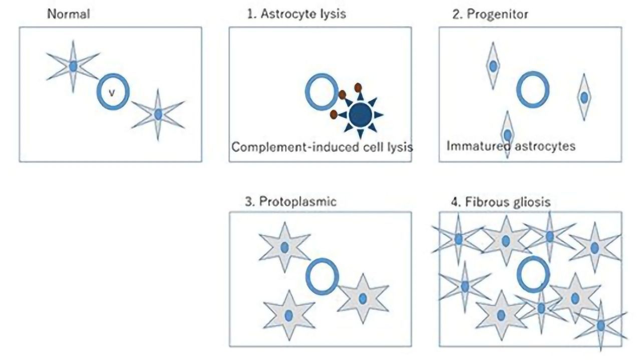 New Classification System Developed for MS-Like Syndrome