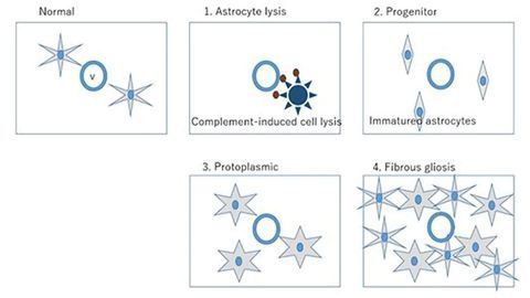 New Classification System Developed for MS-Like Syndrome