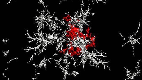 Plaque Protect: Study Makes Surprising Finding About Alzheimer's Hallmark