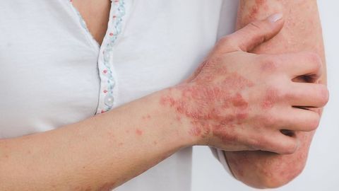 Factor in Psoriasis Episode Development Discovered