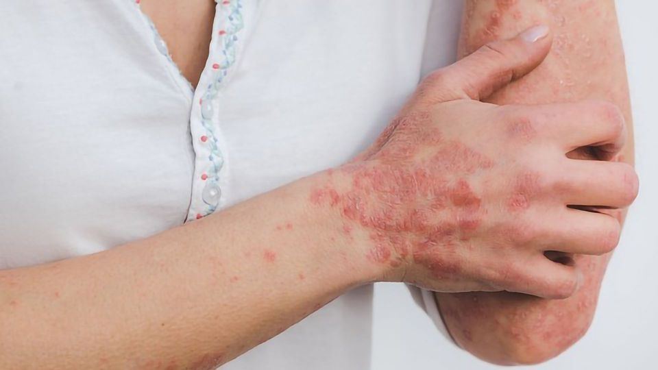 Factor in Psoriasis Episode Development Discovered content piece image