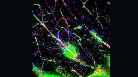 Our Immune System Links the Blood-Brain Barrier to Schizophrenia