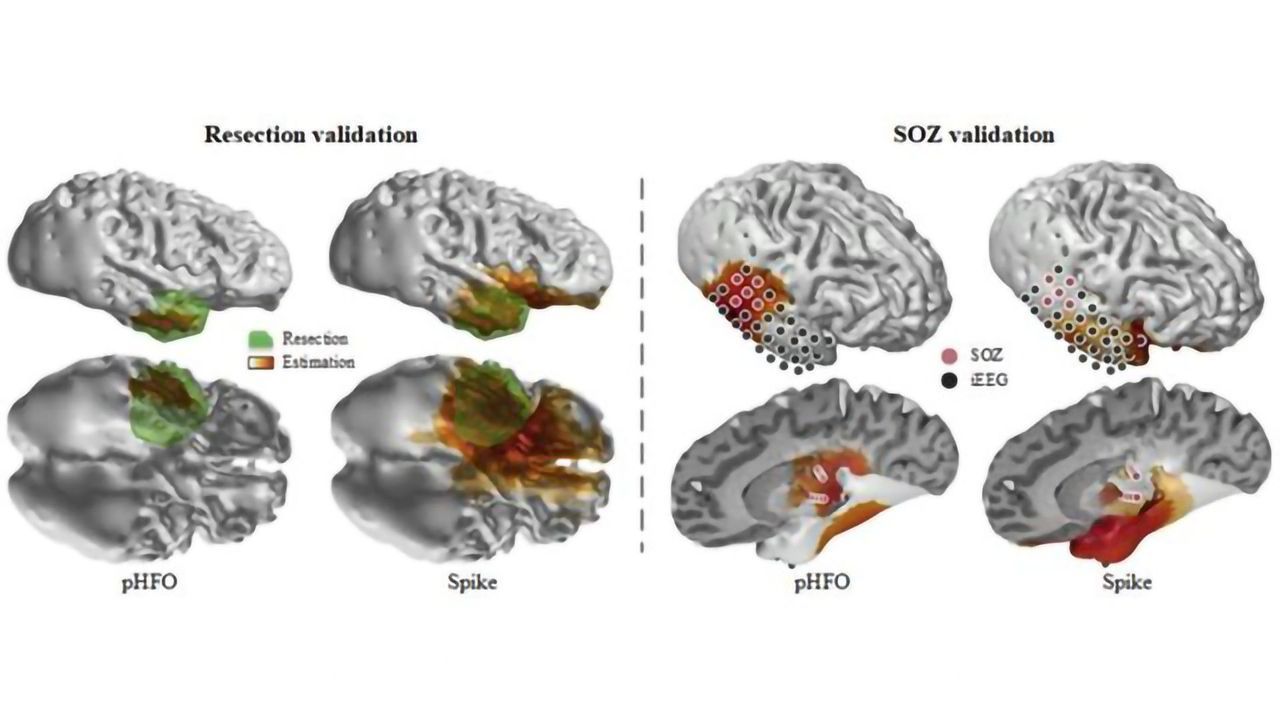 Scalp Recordings Pin Down the Origin of Epileptic Seizures