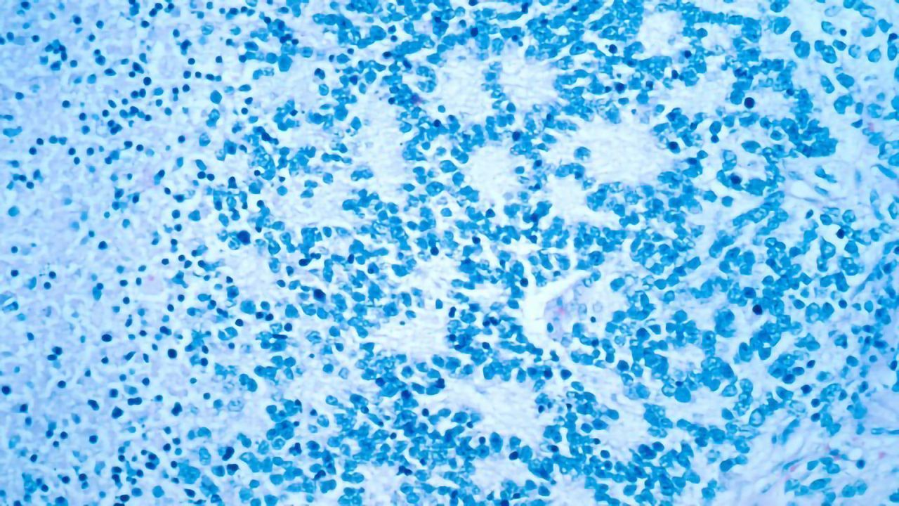 Possible Cellular Origin of Neuroblastoma Discovered
